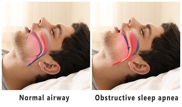 What Causes Racing Heart When Waking Up